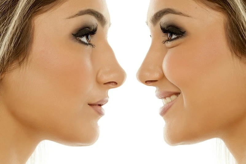 nos przed i po operacji